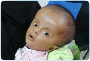 Hydrocephalus Project