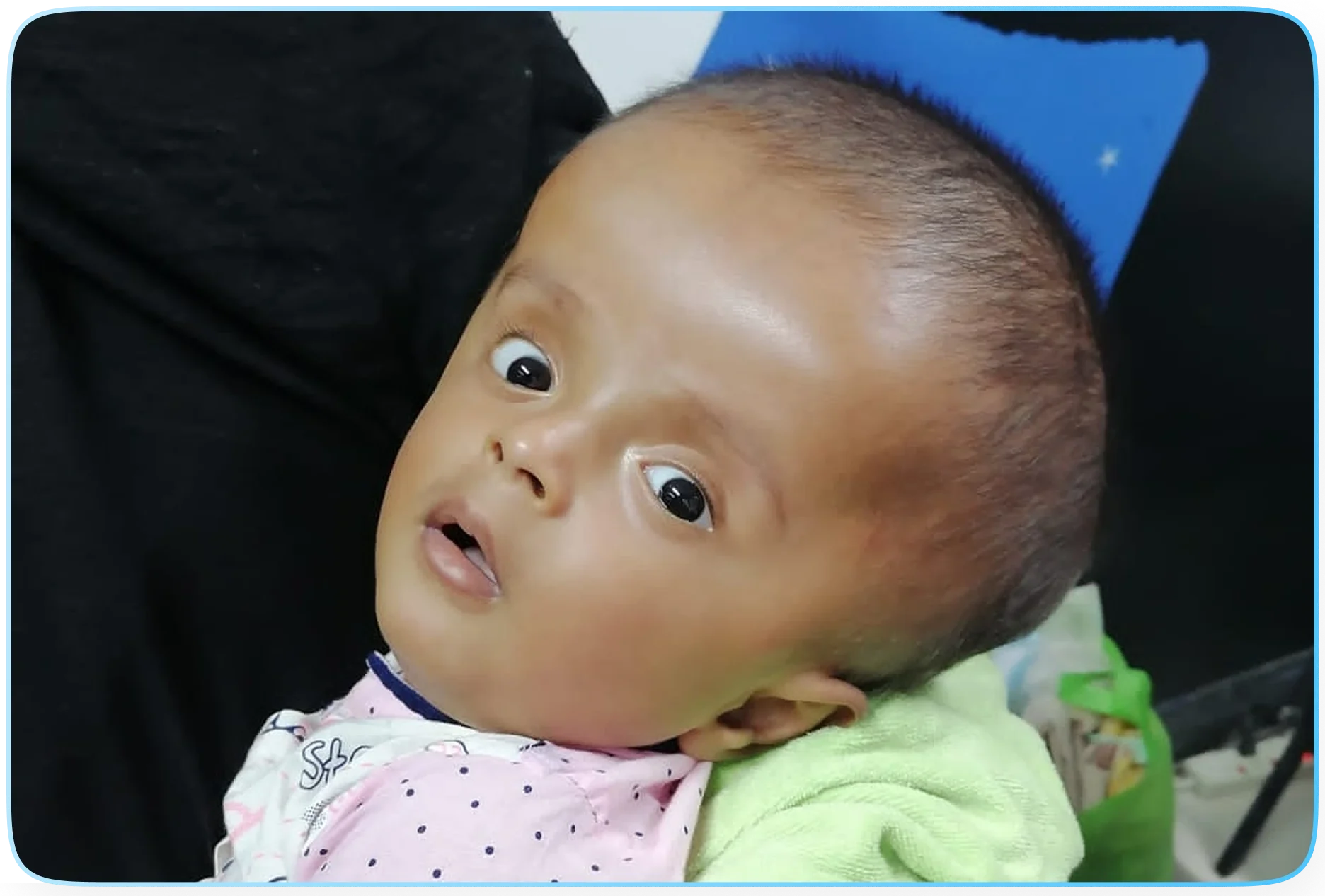 Hydrocephalus Project