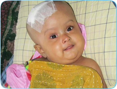 Hydrocephalus