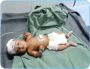 Hydrocephalus2