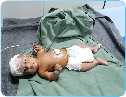 Hydrocephalus2