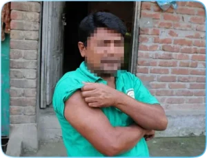 Leprosy1